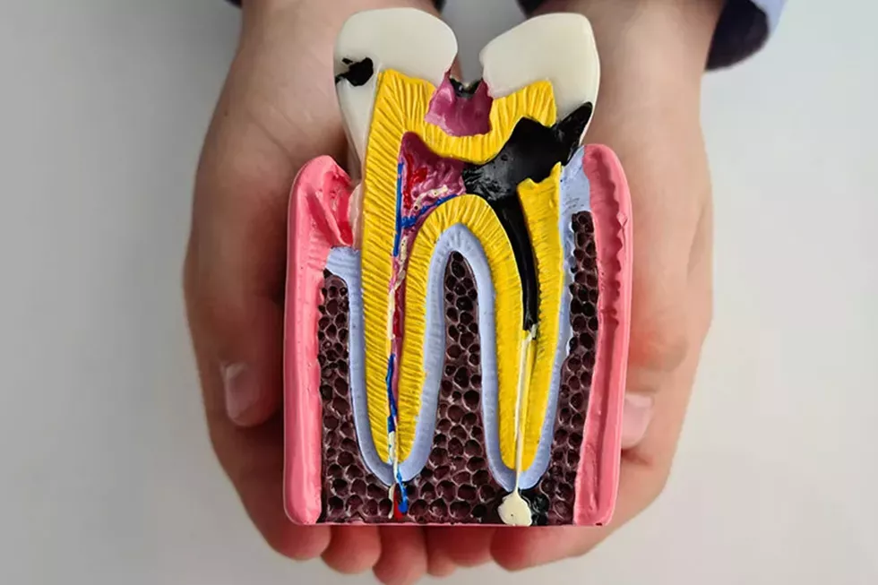 Anatomie eines Karies Zahnes